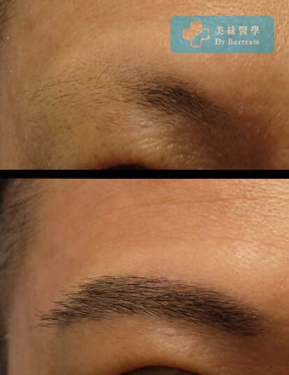 eyebrow hair transplant before and after