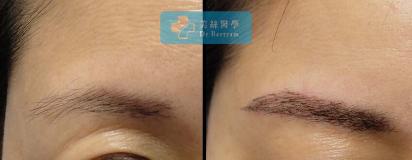 Eyebrow Hair Scar Transplant