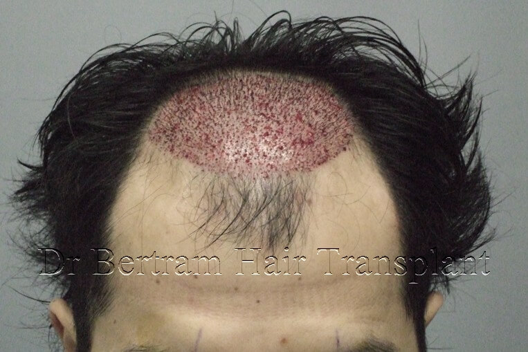 hair transplant before and after photo