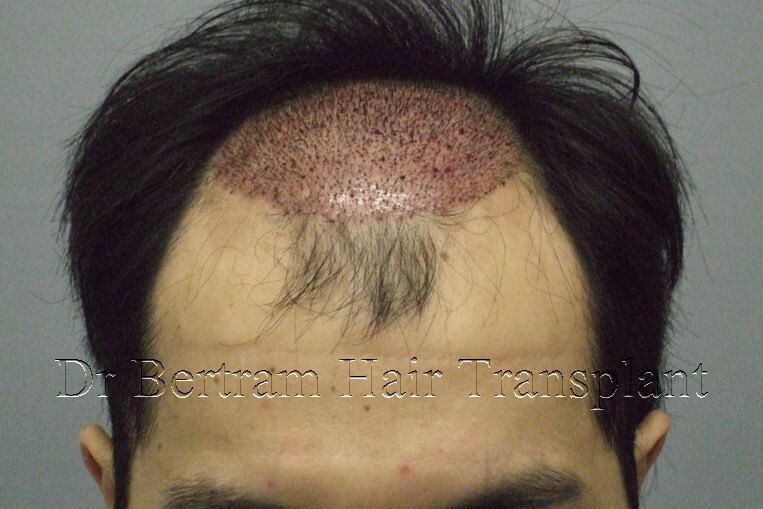 hair transplant before and after photo