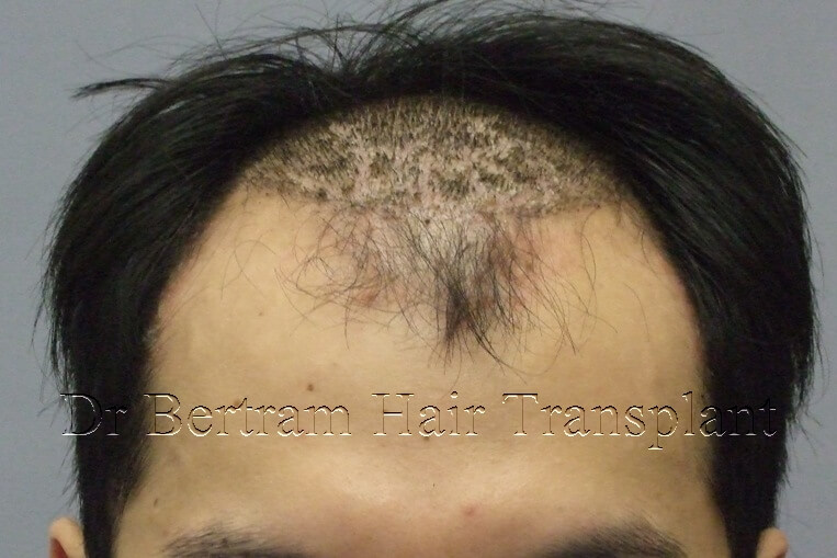 hair transplant before and after photo