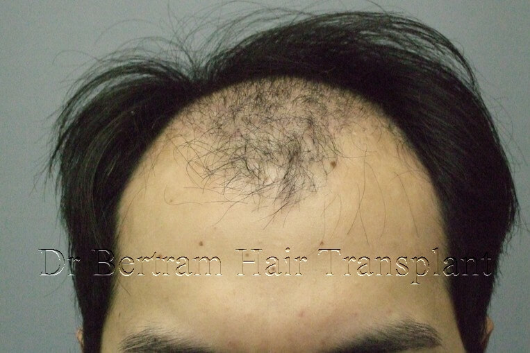 hair transplant before and after photo