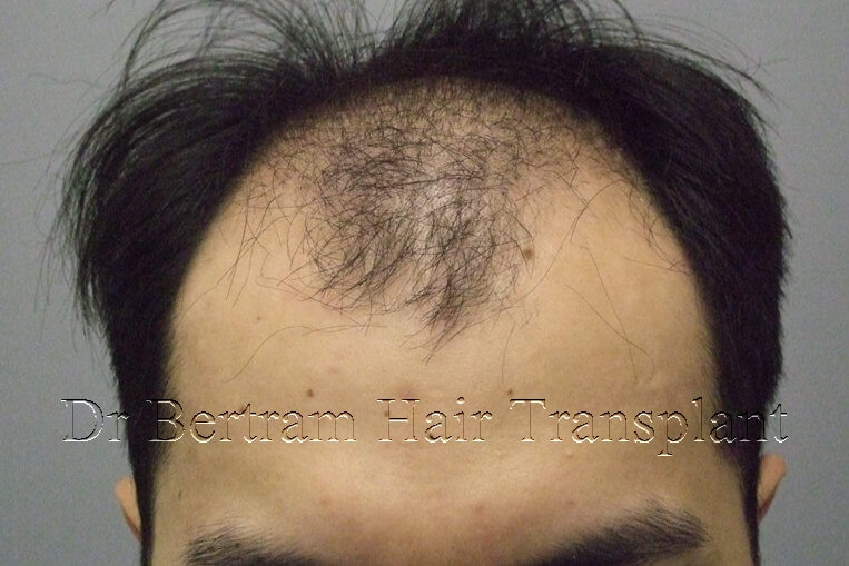 hair transplant before and after photo