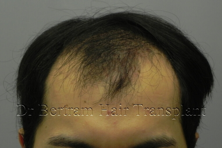 hair transplant before and after photo