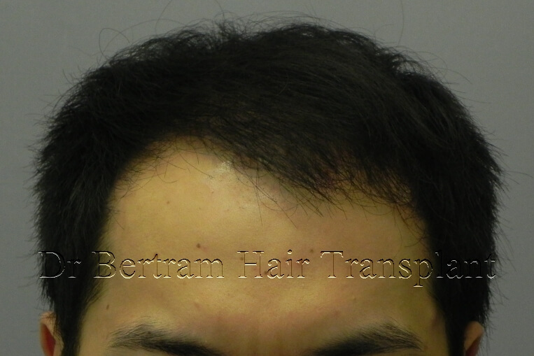 hair transplant before and after photo