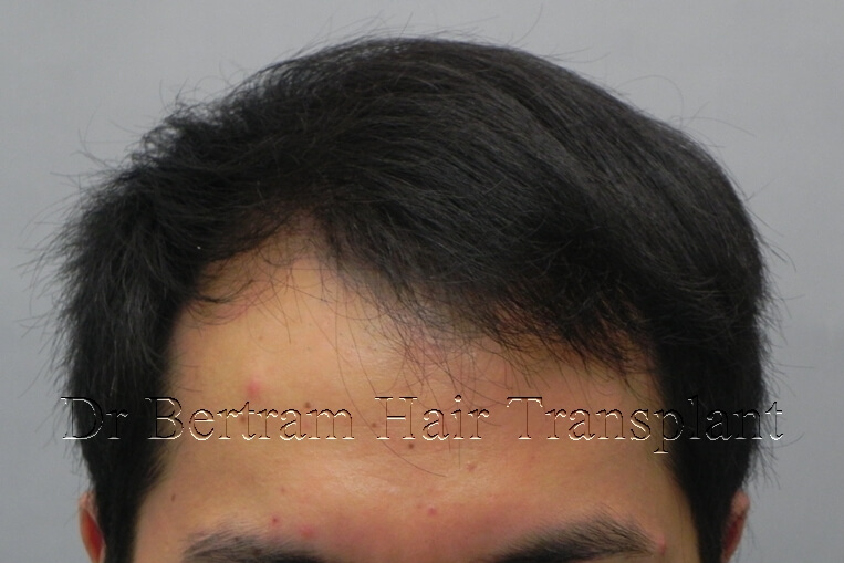 hair transplant before and after photo