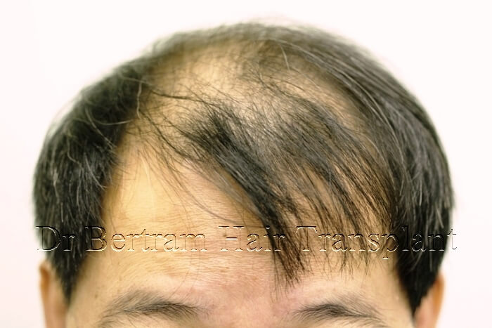 hair transplant before and after photo