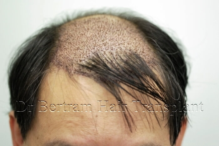 after 1 month of hair transplant