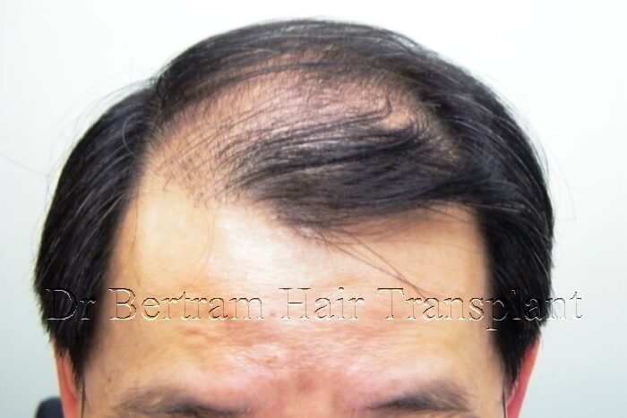 hair transplant before and after photo