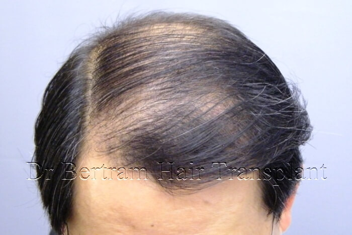 5 months after hair transplant