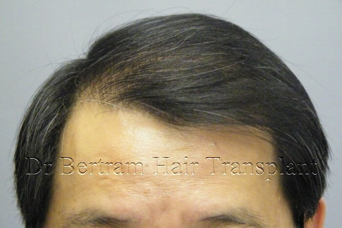 hair transplant before and after photo