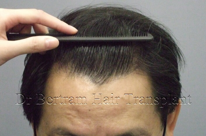 hair transplant before and after photo