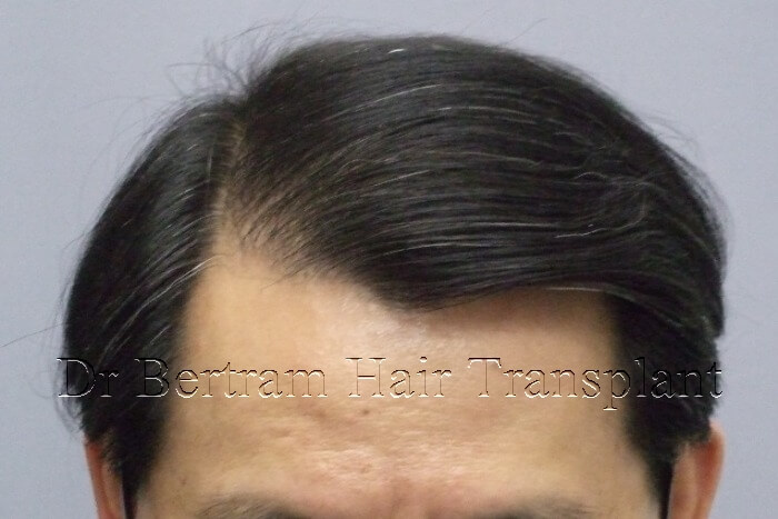 hair transplant before and after photo