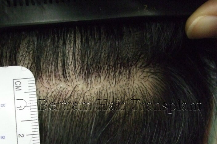 hair transplant before and after photo