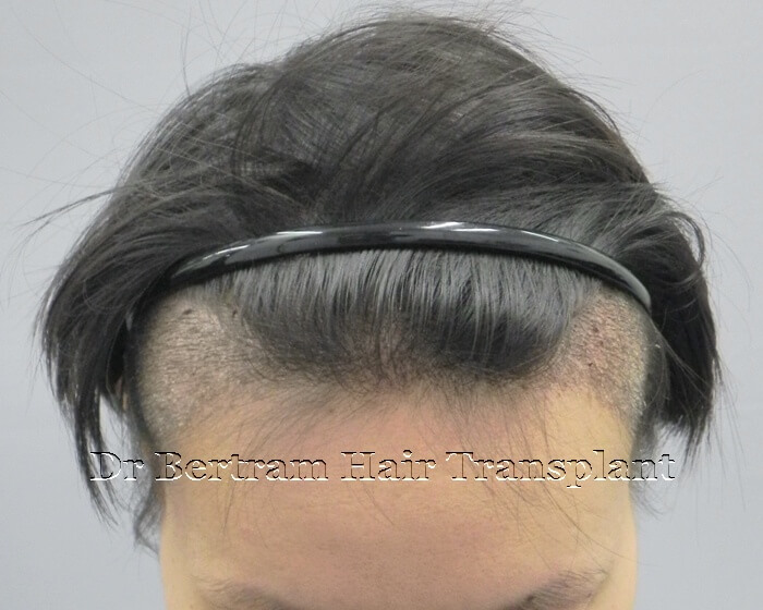 hair transplant before and after photo