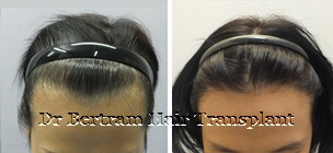 hair transplant before and after picture women