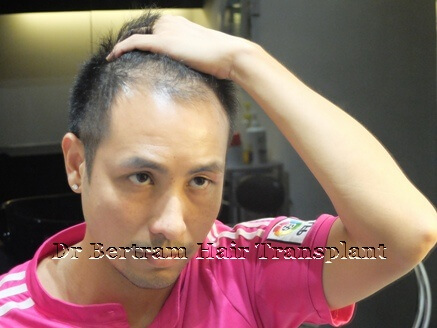 FUT hair transplant surgery