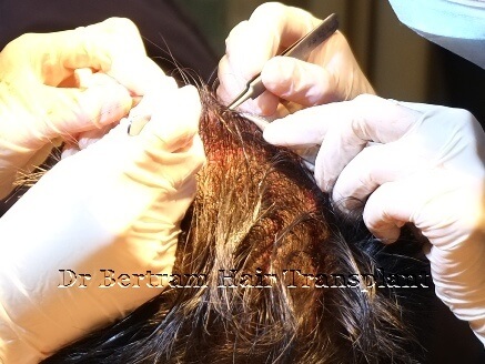 FUT hair transplant hk