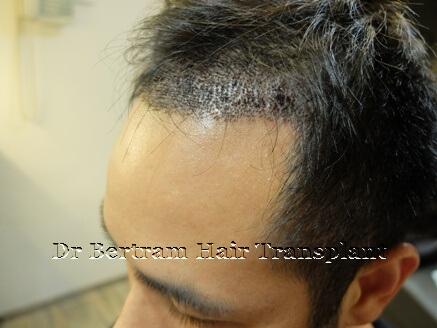 FUT hair transplant