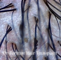 alopecia areata