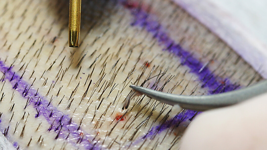 FUE procedure