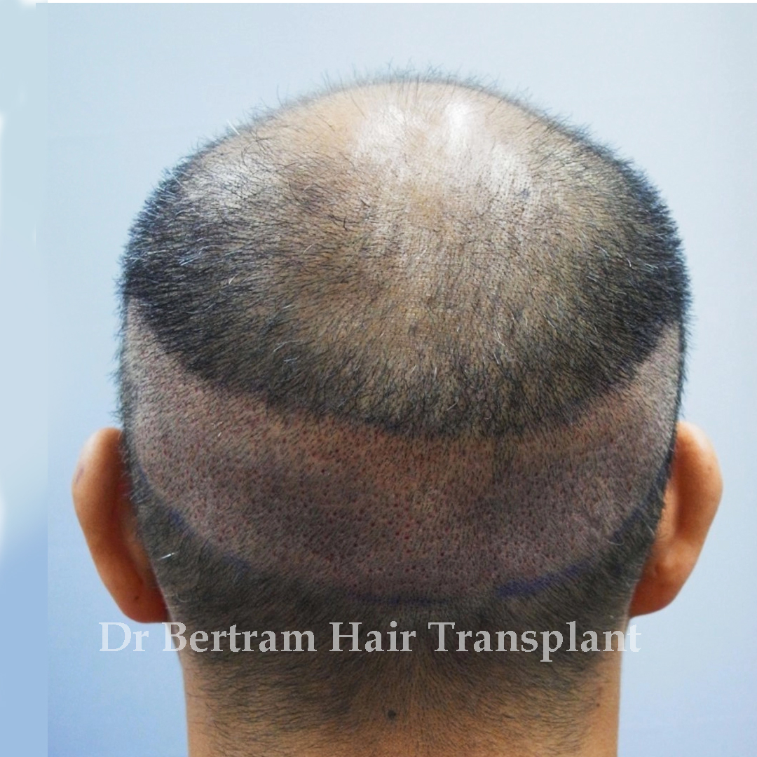 Grafts should be extracted carefully