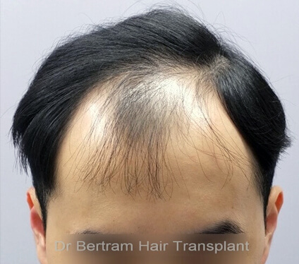 Receding hairline