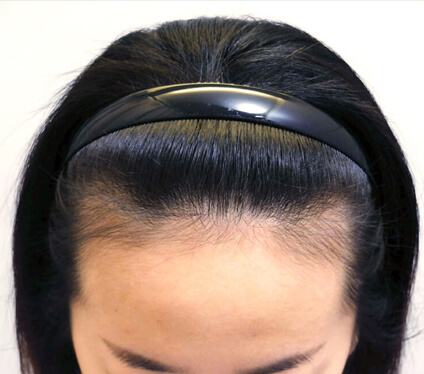 High forehead