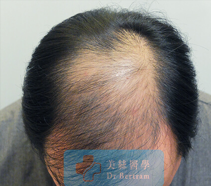 Thinning vertex crown