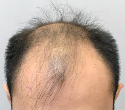 Extensive balding