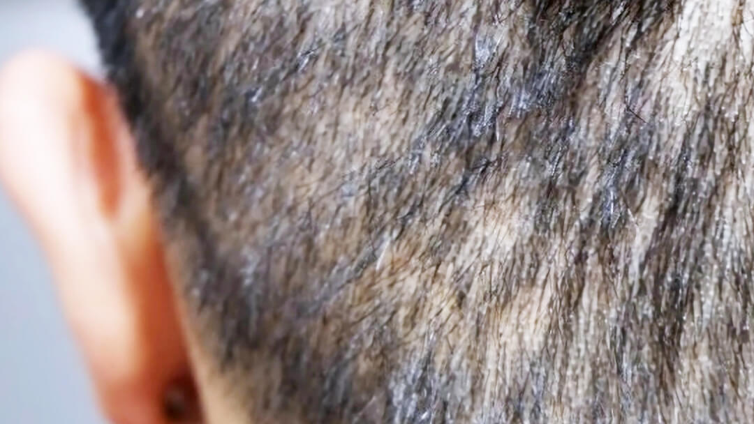 Irreversible thinning in the donor area