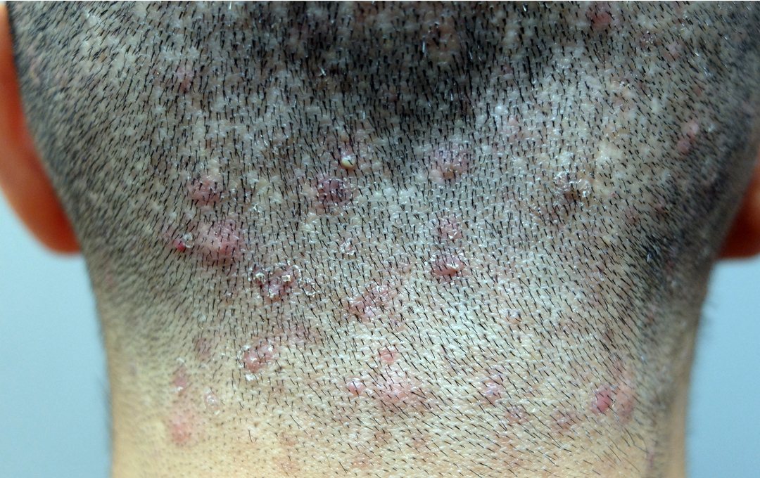 Patient donor area 12 months after surgery