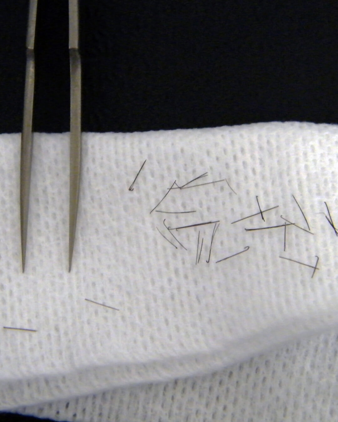 Treatment of folliculitis via drainage or fragment removal