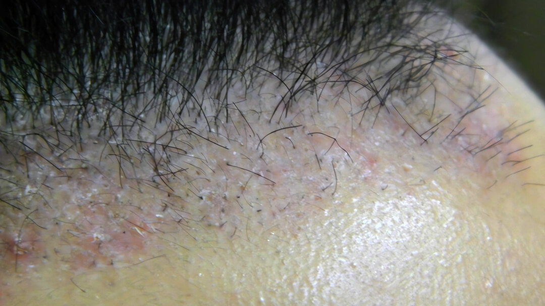 Diagram illustrating types of folliculitis and prevention methods