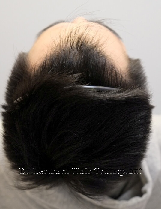 術後12個月：頭頂角度