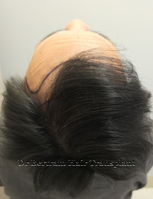 術前：右側角度