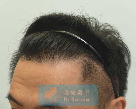 術後12個月：髮際線恢復