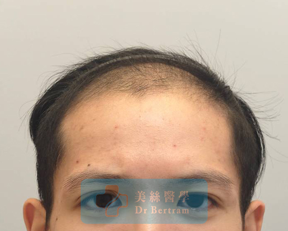 術前：IVa期前額髮際線上移