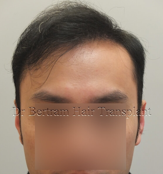 術後12個月：正面角度