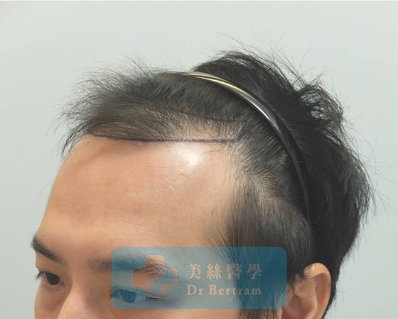術前：頭頂中部，頭頂穩定