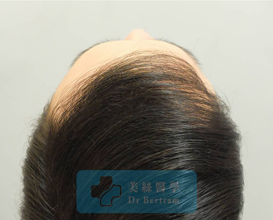 術後：顳部連接恢復
