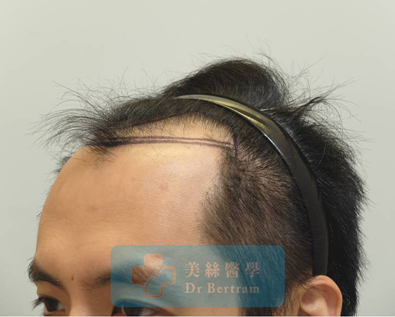 術前：IIIa期前額髮際線上移