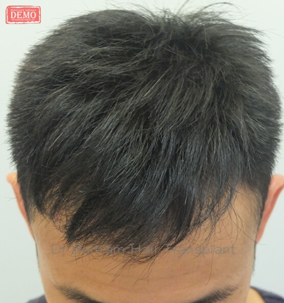 術後12個月：正面角度