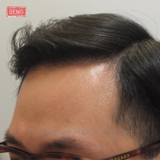 術後12個月：後方角度