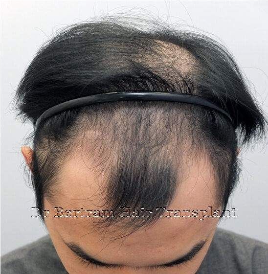 術前：左側角度