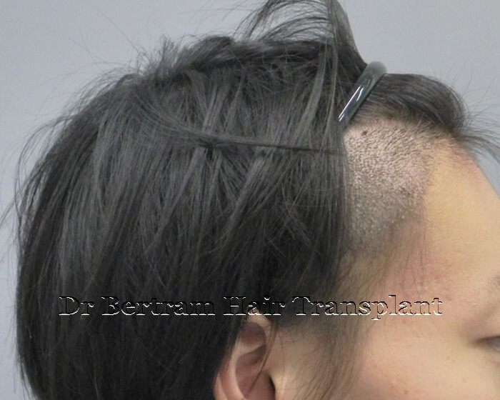 術後1週：頭頂角度