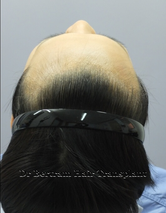 術前：頭頂稀疏