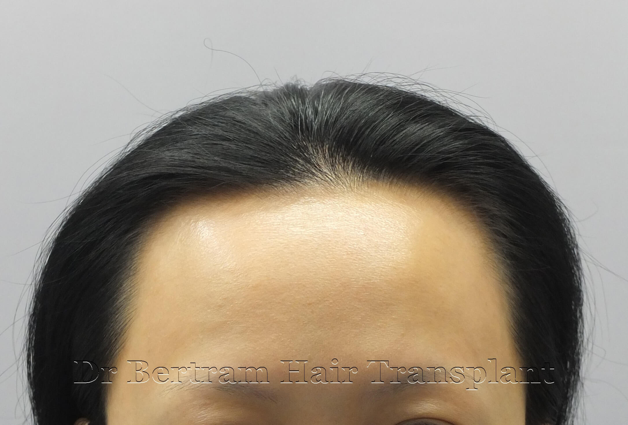 術前：正面角度顯示髮際線稀疏