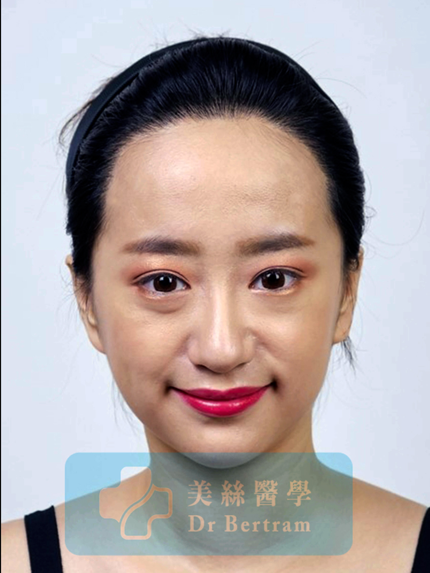 12 months post-procedure