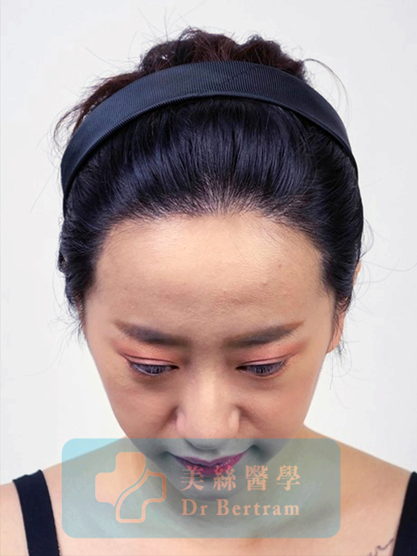 12 months post-procedure
